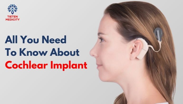 All You Need To Know About Cochlear Implant