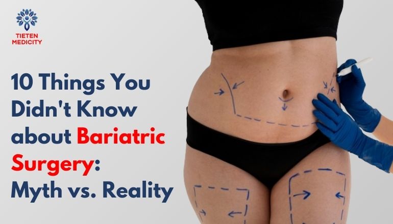 10 Things You Didn’t Know about Bariatric Surgery: Myth vs. Reality