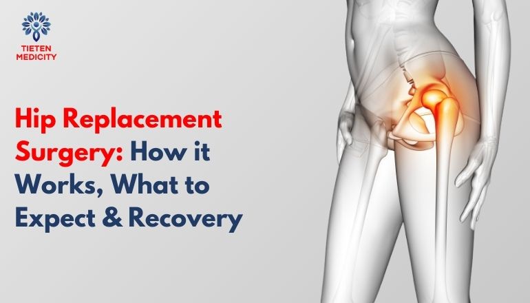 Hip Replacement Surgery: How it Works, What to Expect & Recovery